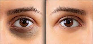 Kem trị thâm quầng mắt có hiệu quả không?