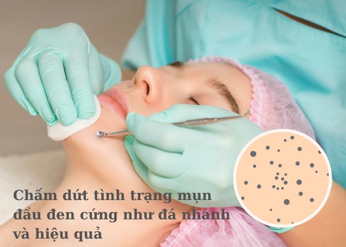 Chấm dứt tình trạng mụn đầu đen cứng như đá nhanh và hiệu quả