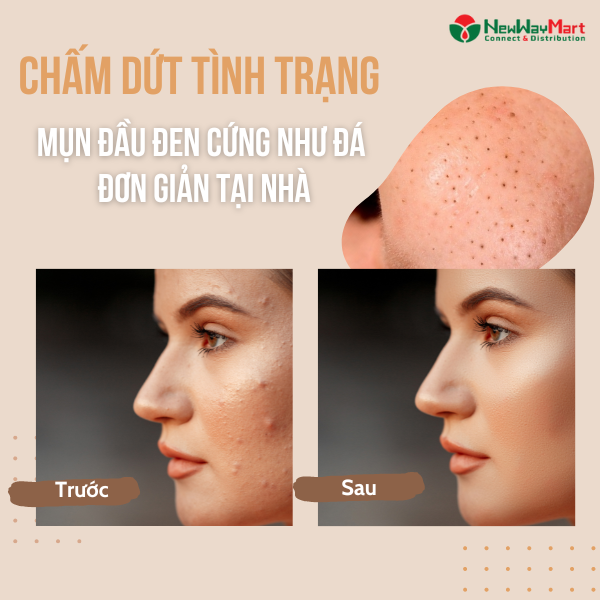 Chấm dứt tình trạng mụn đầu đen cứng như đá nhanh và hiệu quả