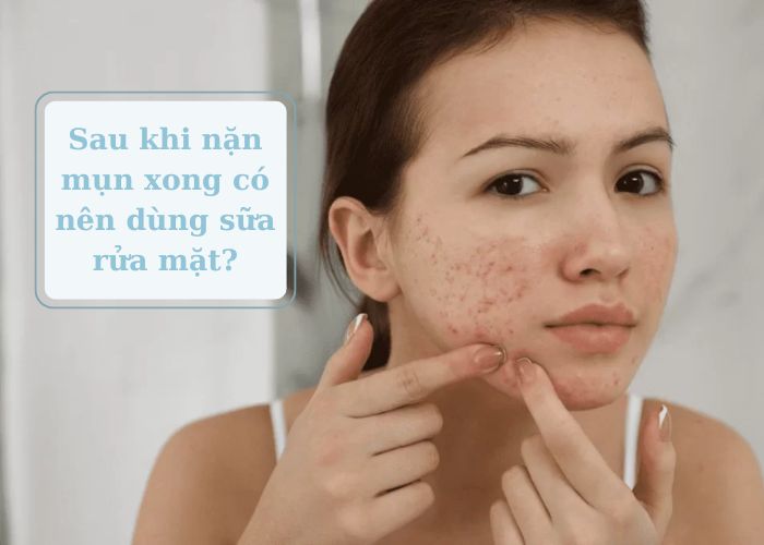 [Giải đáp thắc mắc] Sau khi nặn mụn xong có nên dùng sữa rửa mặt?