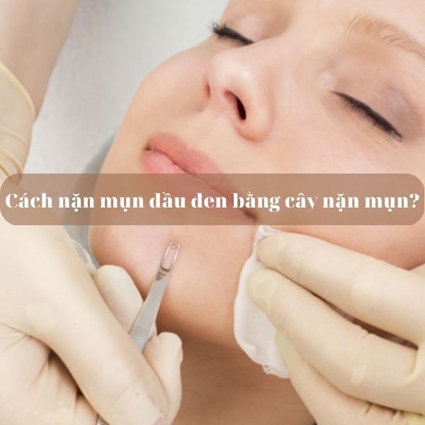 Có nên nặn mụn đầu đen? Cách nặn mụn đầu đen bằng cây nặn mụn