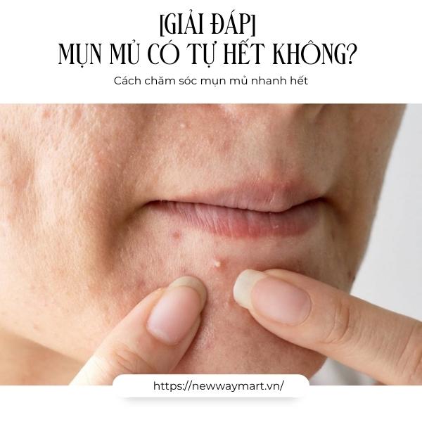 [Giải đáp] Mụn mủ có tự hết không? Cách chăm sóc mụn mủ nhanh hết