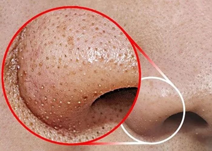 Chia sẻ cách Xử lý mụn đầu trắng ở mũi đơn giản tại nhà